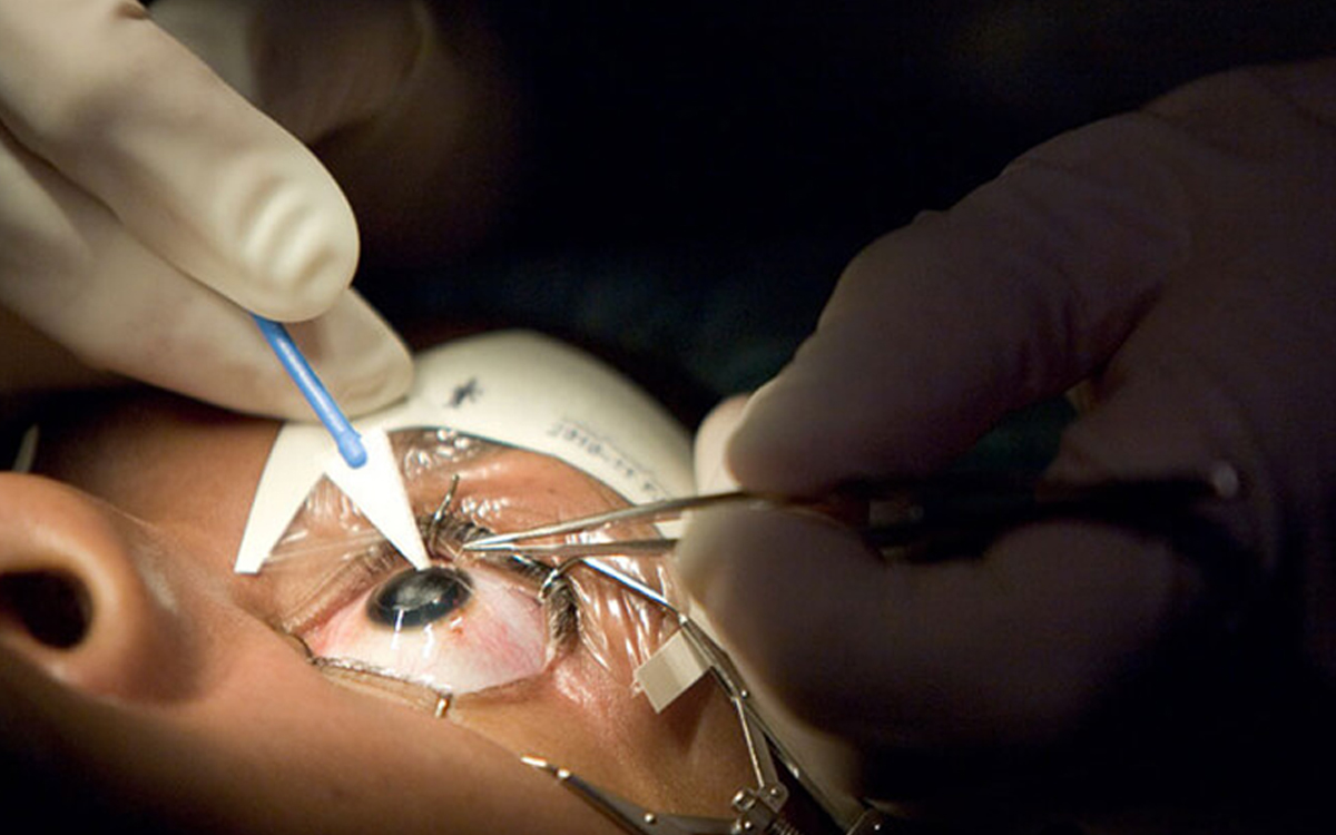 Refractive Surgery Explained